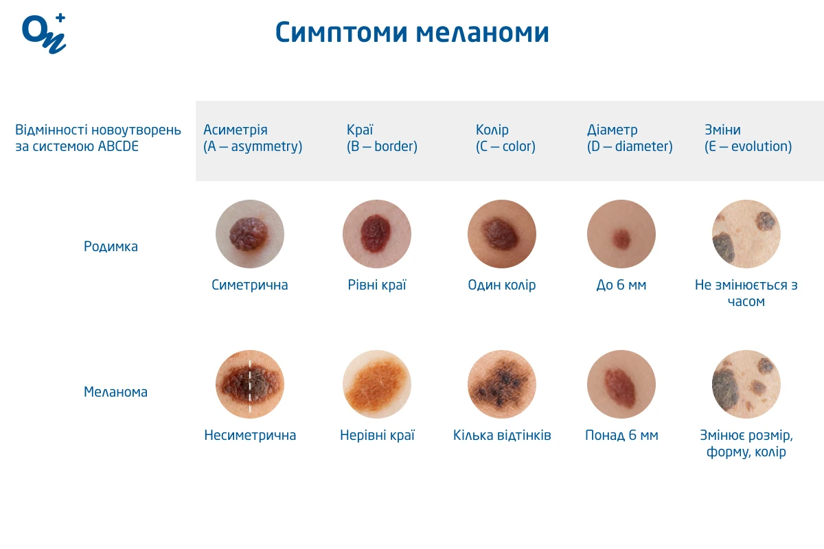 Зовнішні відмінності родимки від меланоми
