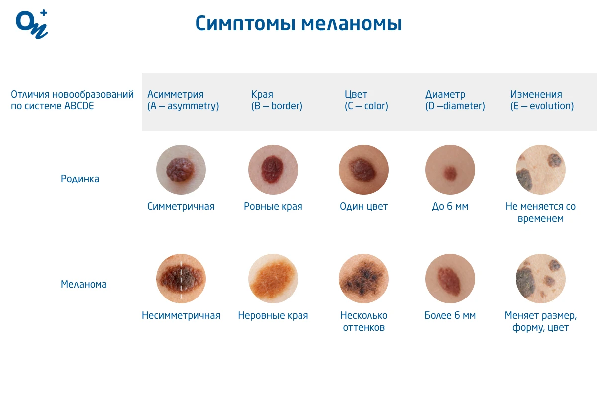 Внешние отличия родинки от меланомы