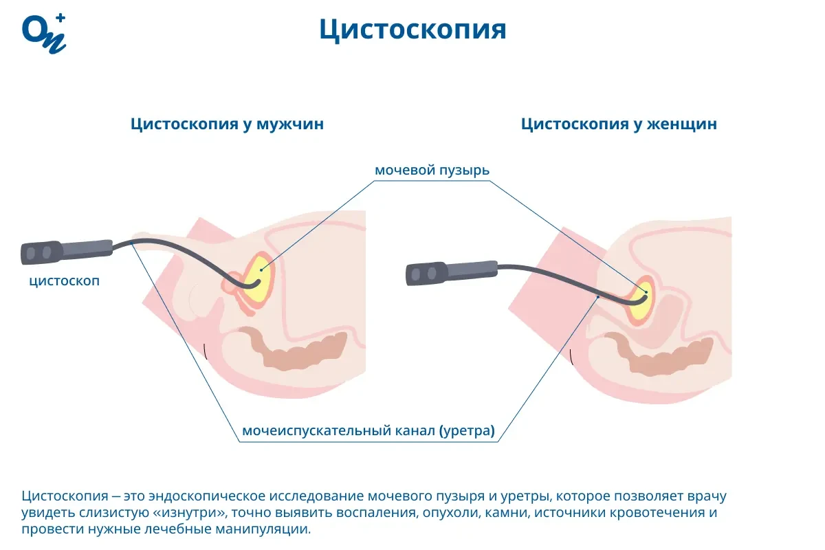 Цистоскопия