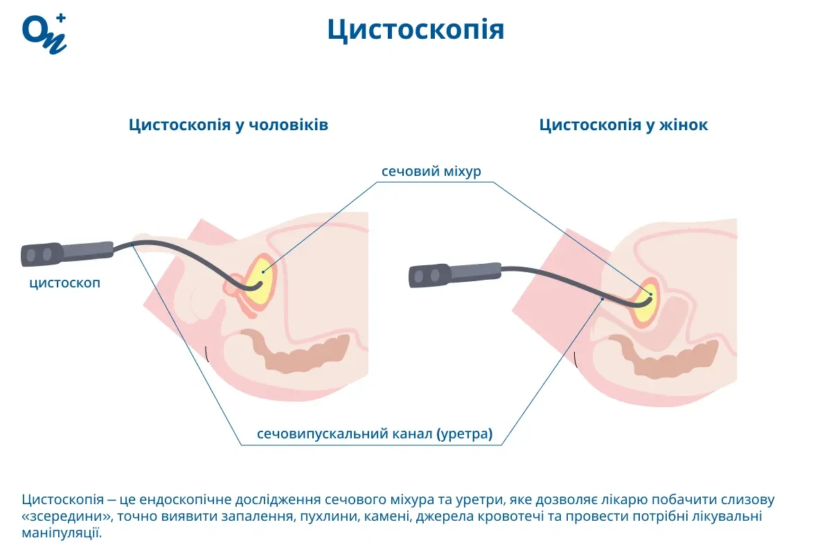 Цистоскопія