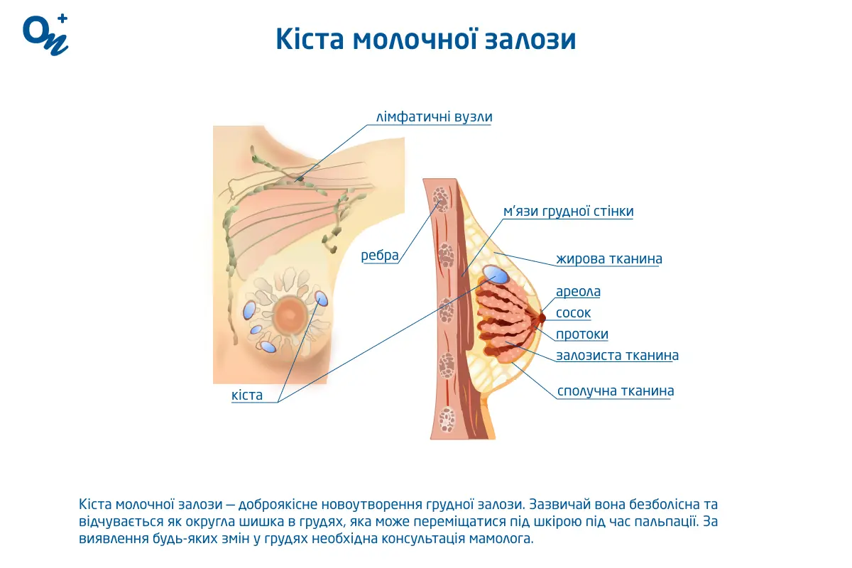 Кіста молочної залози