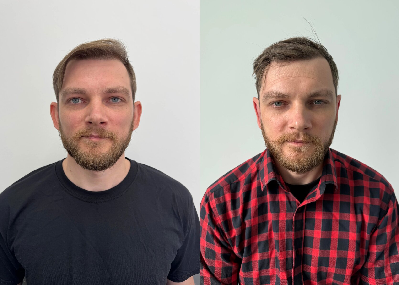 Результати отопластики (лікування клаповухості)