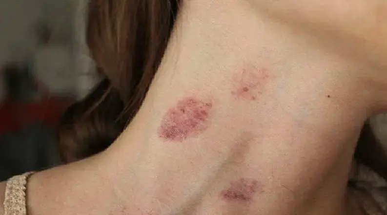 Як виглядає засос?