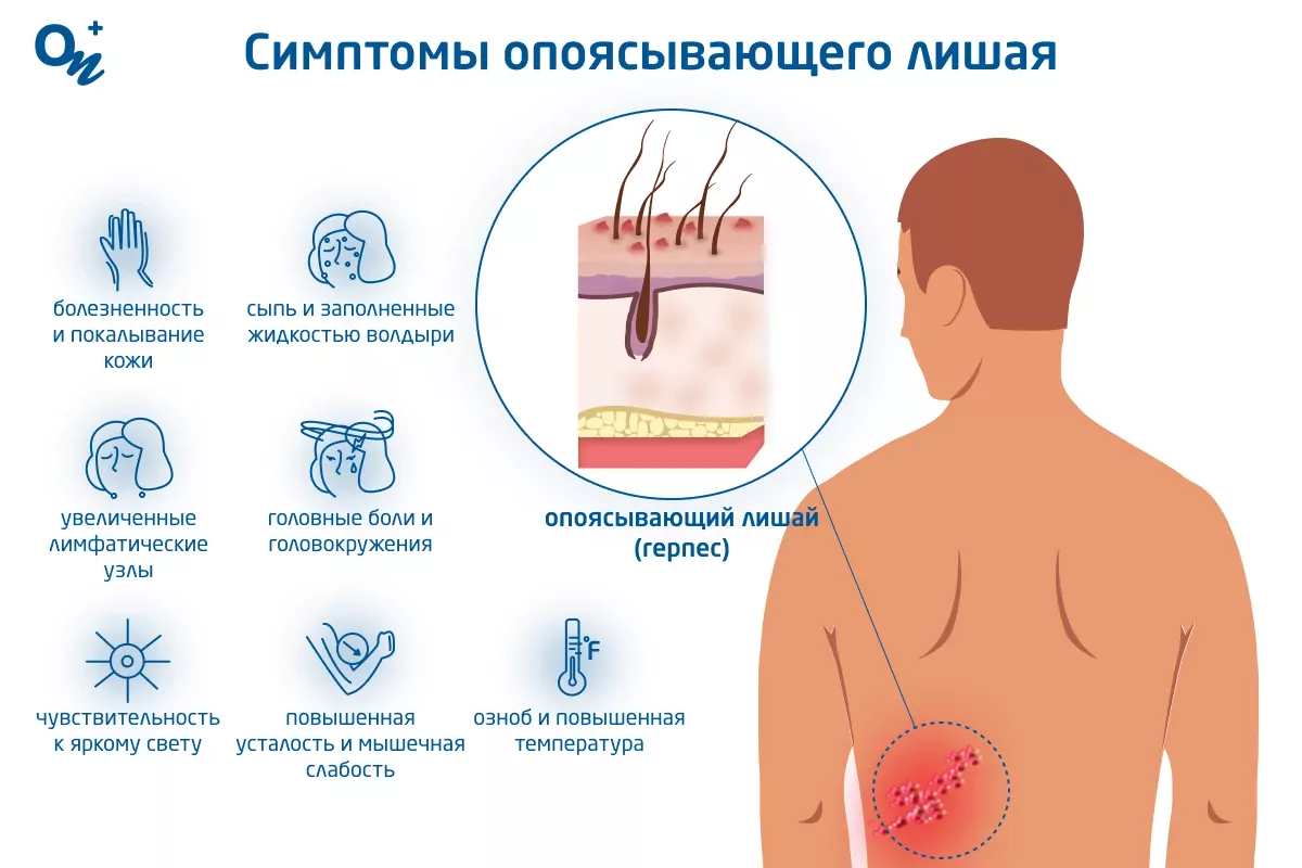 Симптомы опоясывающего лишая и способы его лечения — блог медицинского  центра ОН Клиник