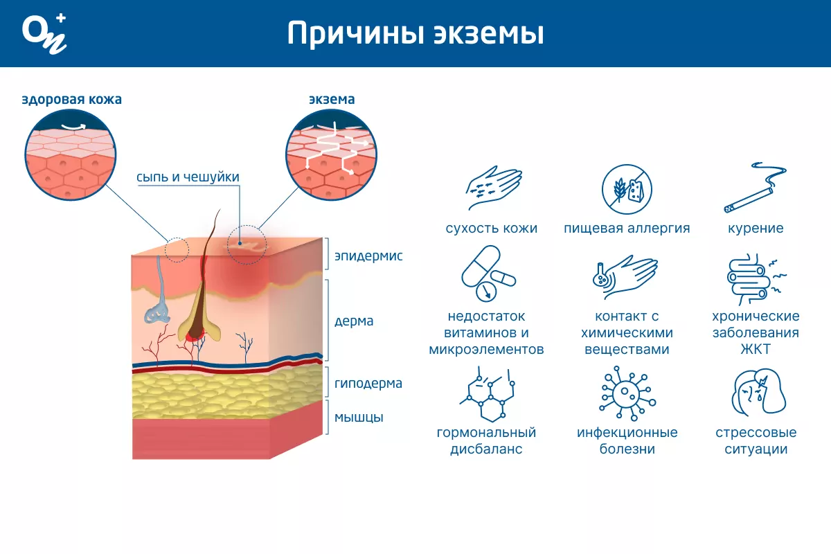 Что нужно знать об экземе — блог медицинского центра ОН Клиник