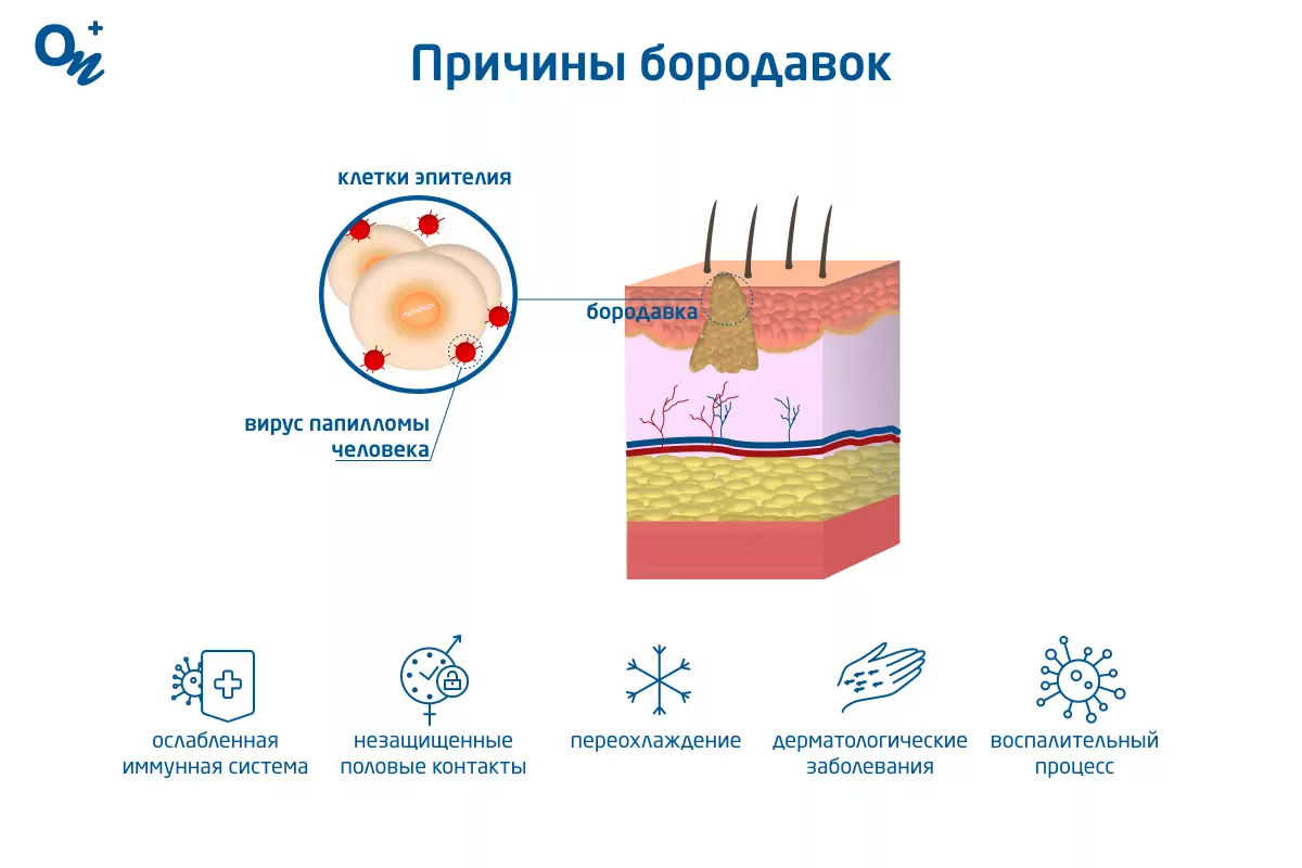 Почему появляются бородавки — блог медицинского центра ОН Клиник