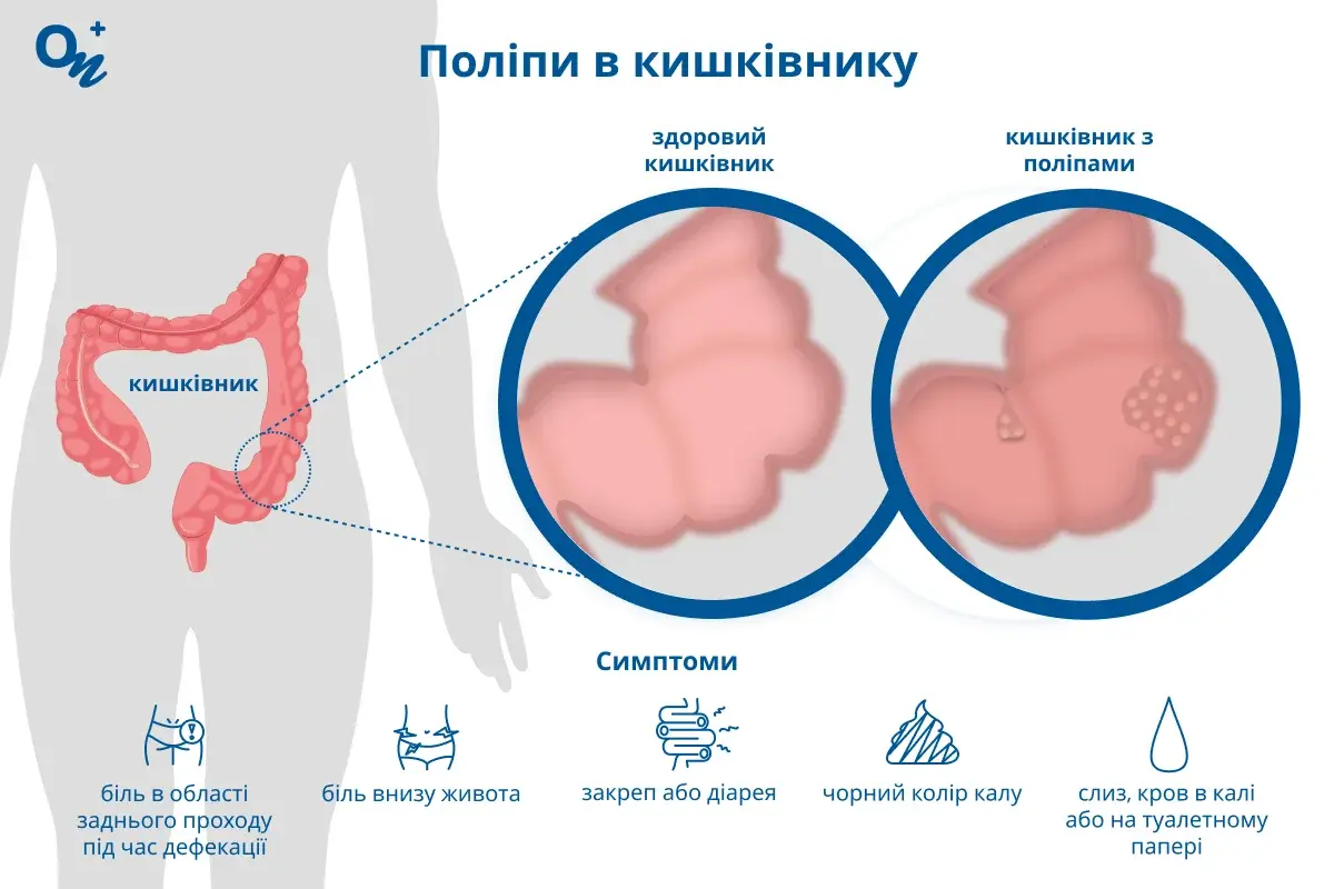 Поліпи в кишківнику