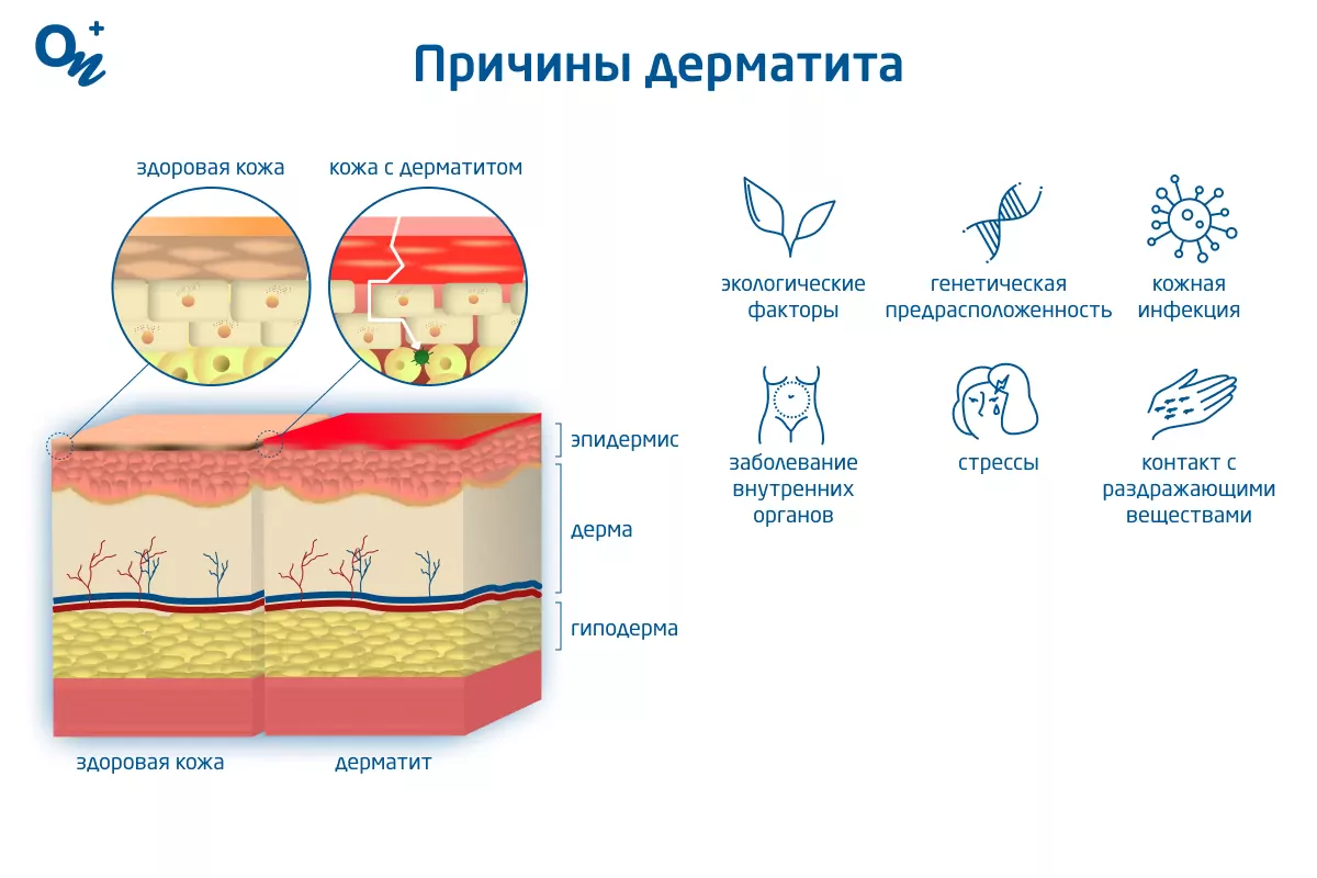 Пеленочный дерматит или опрелость кожи у малыша: что делать? Советы дерматолога