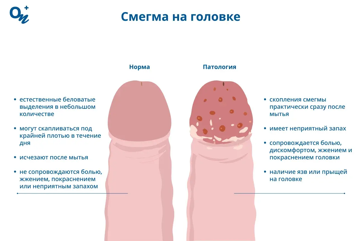 Смегма на головке