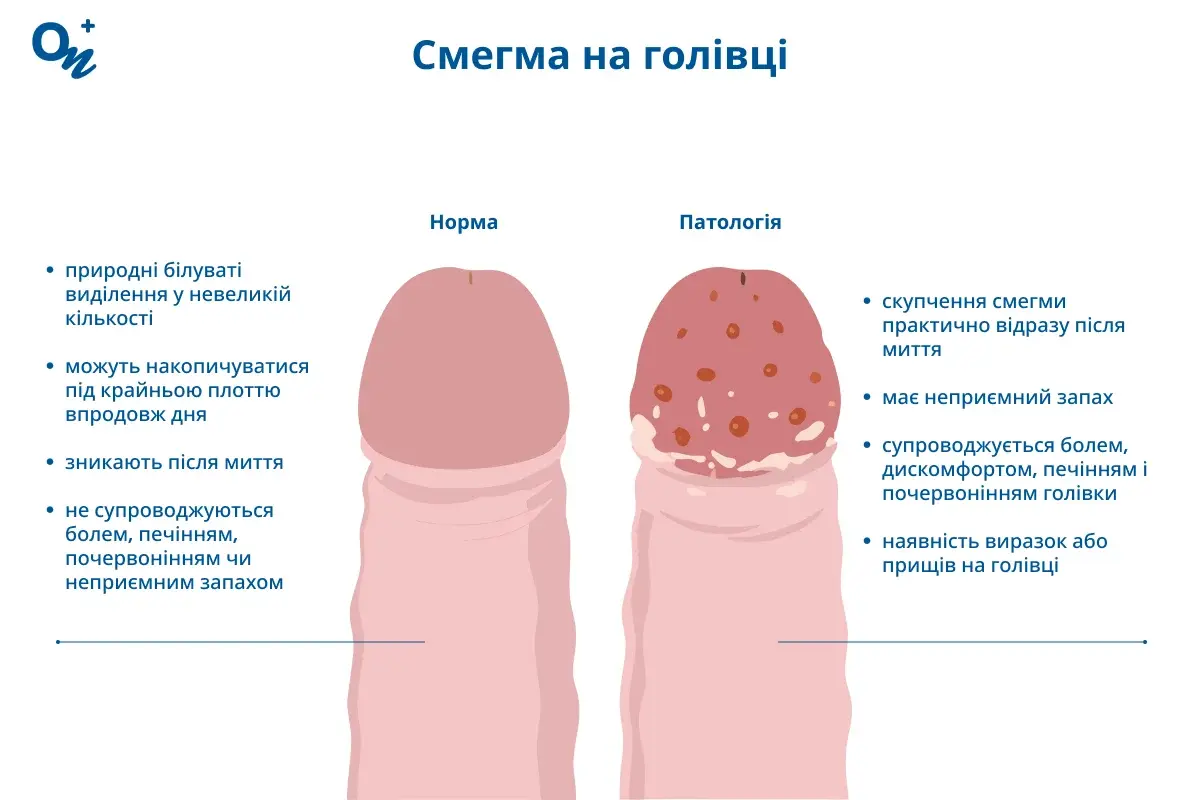 Смегма на голівці