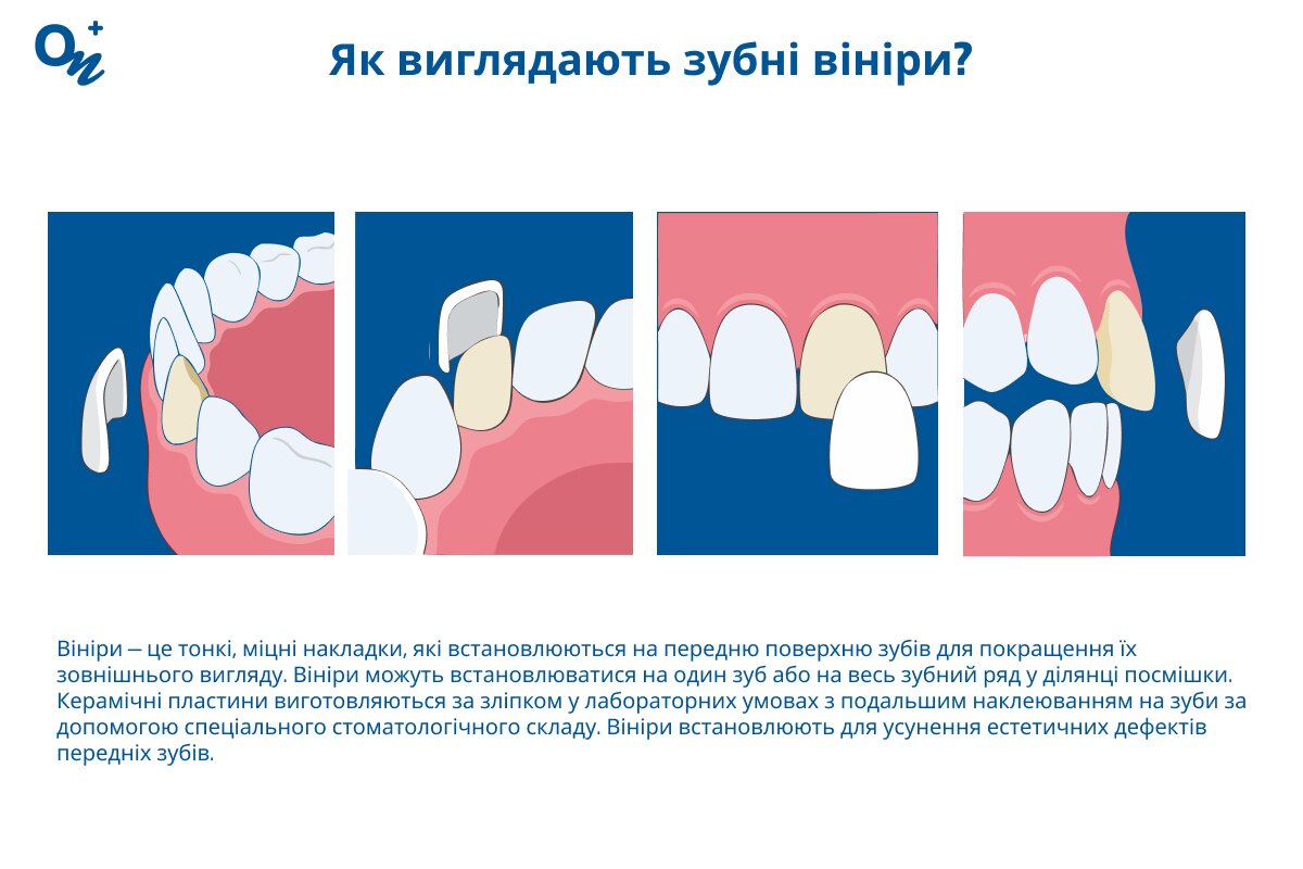 Як виглядають зубні вініри?
