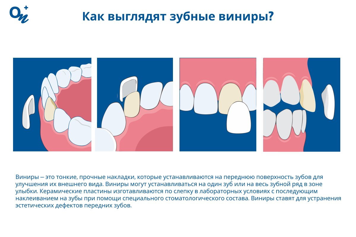 Как выглядят зубные виниры?
