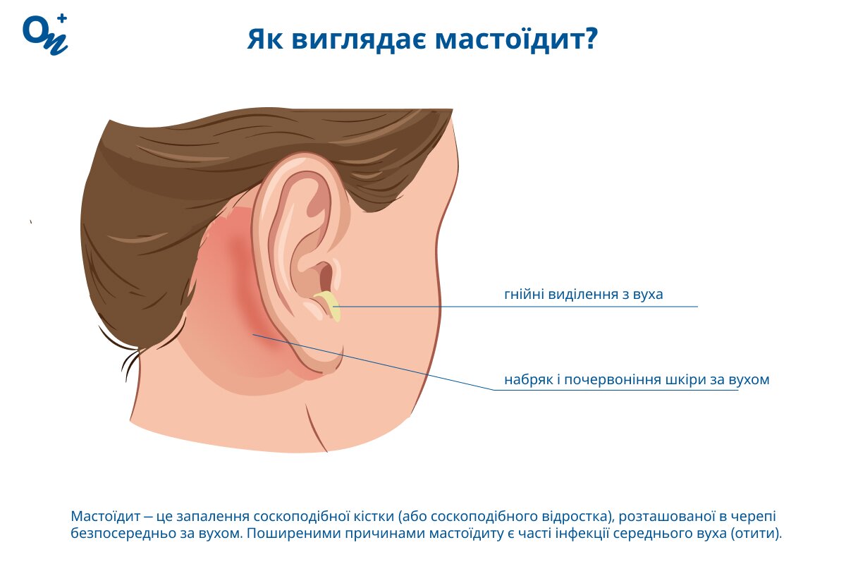 Як виглядає мастоїдит?