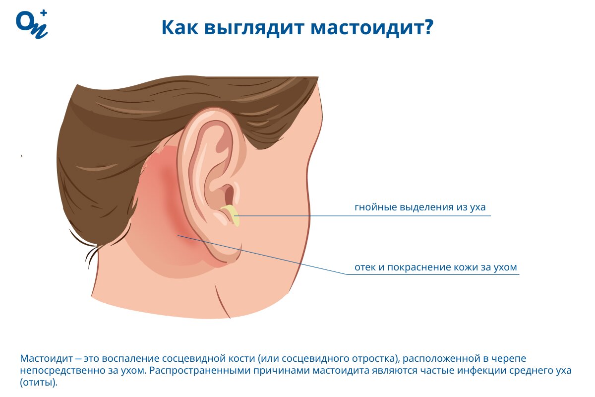 Как выглядит мастоидит?