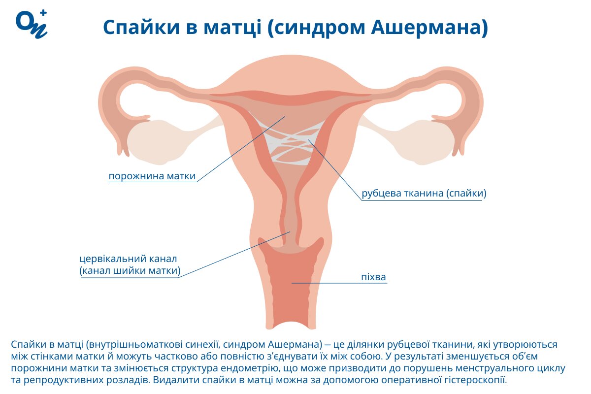 Що таке спайки в матці?