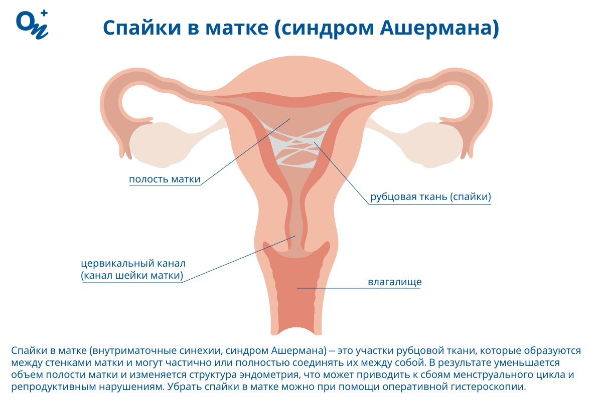 Что такое спайки в матке?