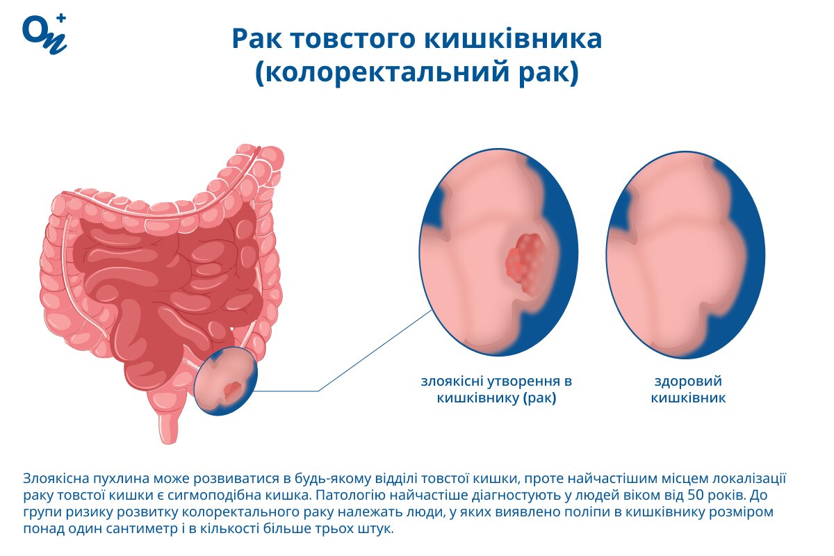 Як виглядає рак товстого кишківника?