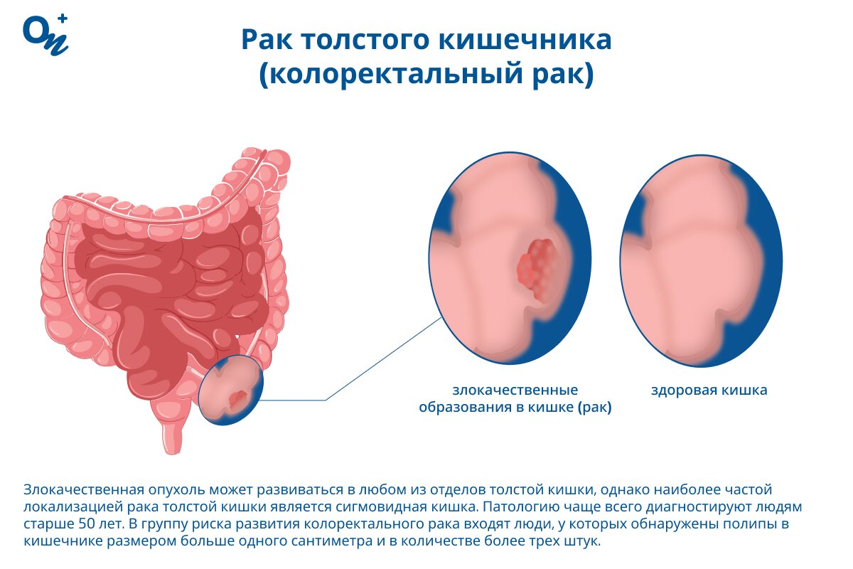 Как выглядит рак толстого кишечника?
