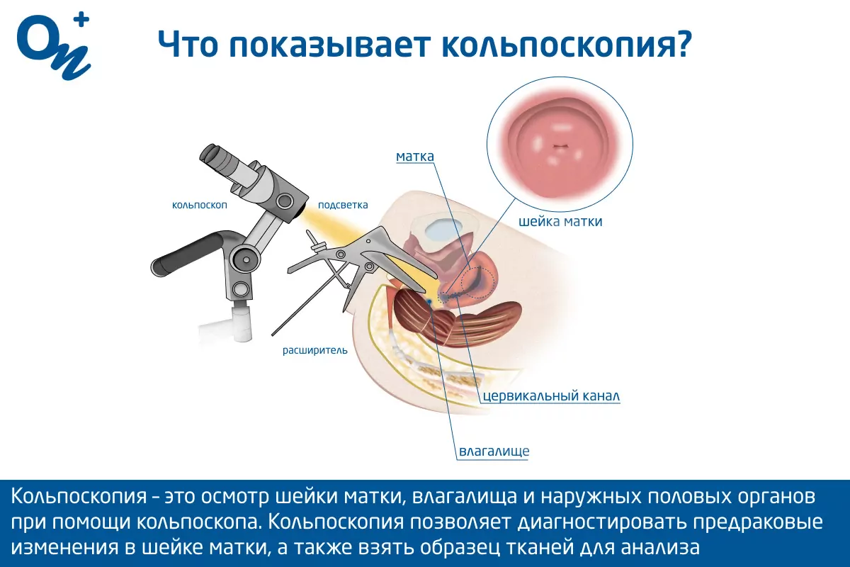 Осмотр вагины у гинеколога Сделать кольпоскопию в Николаеве — осмотр вагины и шейки матки у гинеколога  ОН Клиник Николаев