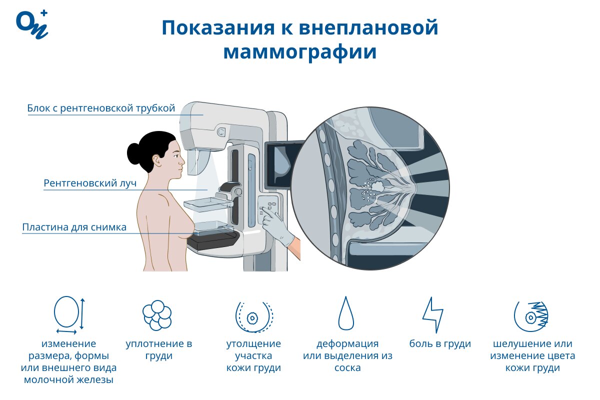 Когда назначают внеплановую маммографию?