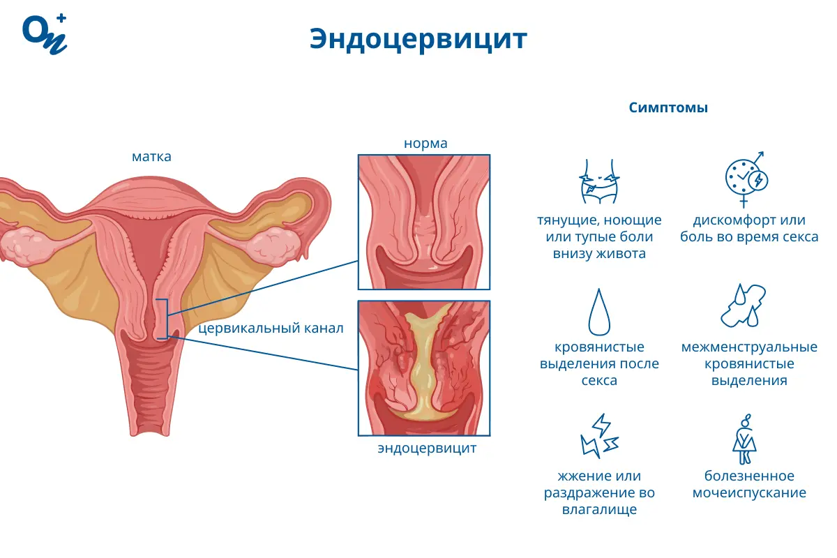 Эндоцервицит