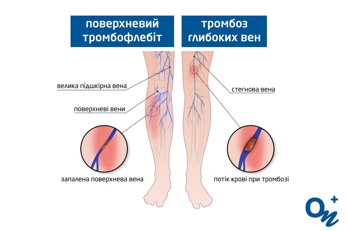 відмінності тромбозу і тромбофлебіту