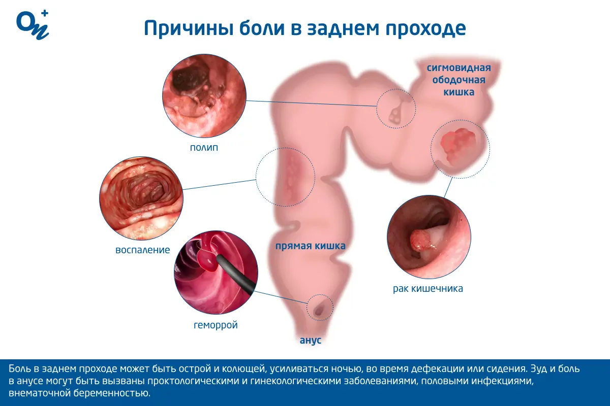 Заболевания кишечника в картинках и фото