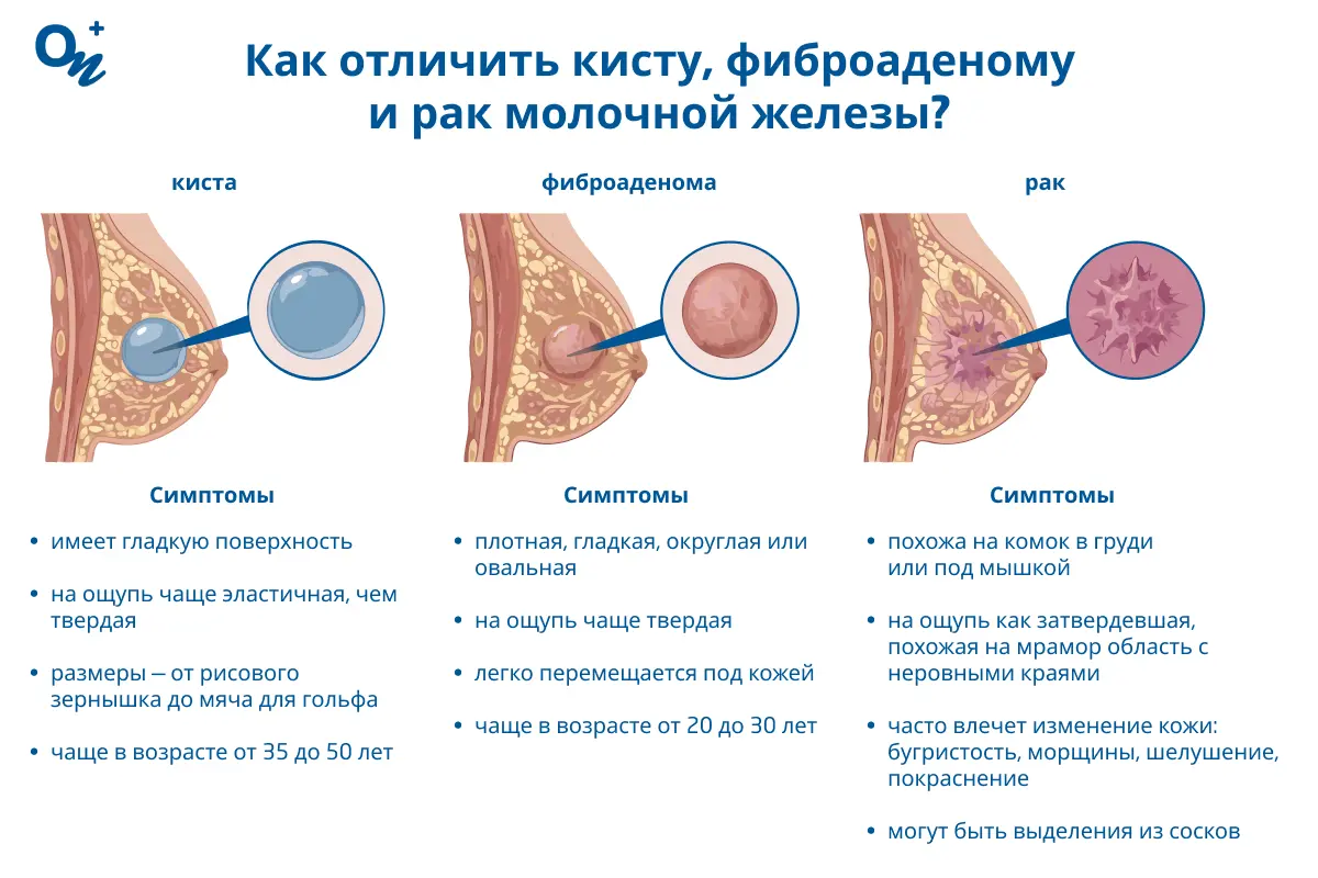 Как отличить кисту, фиброаденому и рак молочной железы?