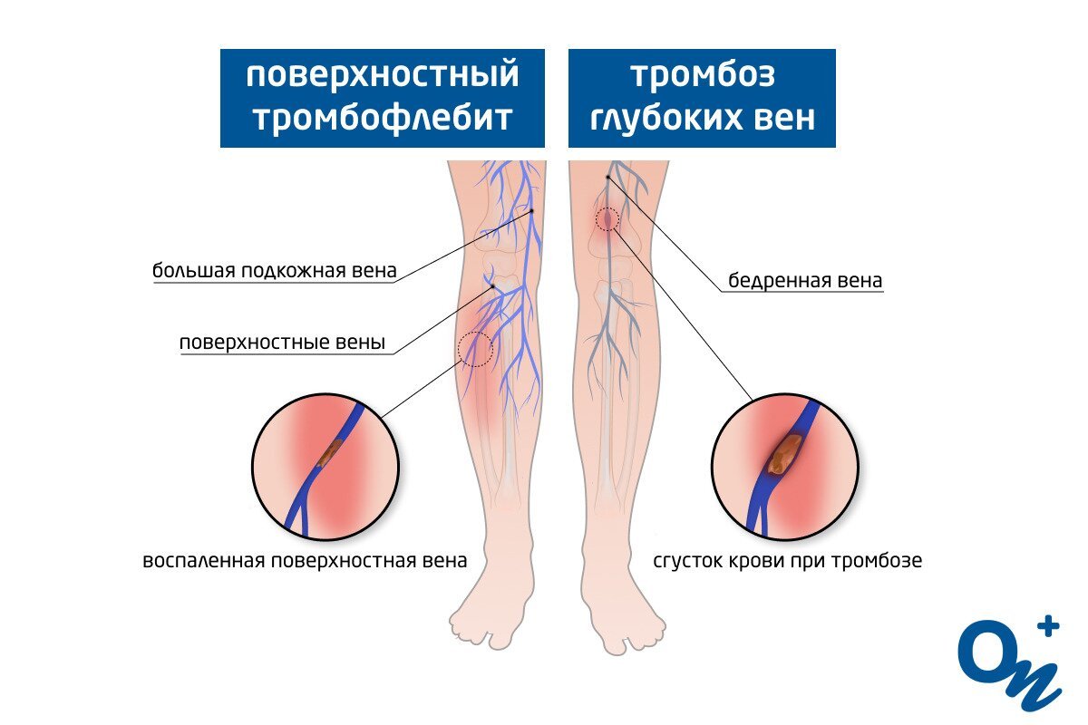 отличия тромбоза и тромбофлебита