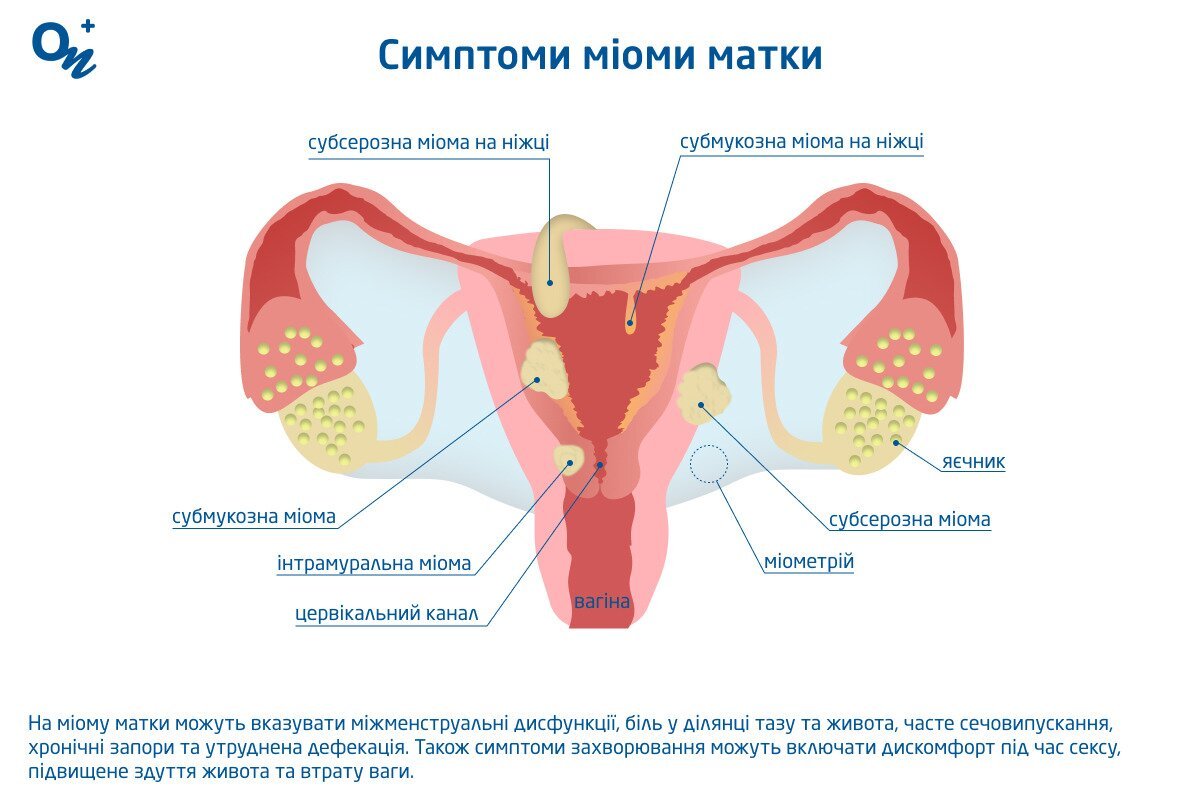 Симптоми міоми матки