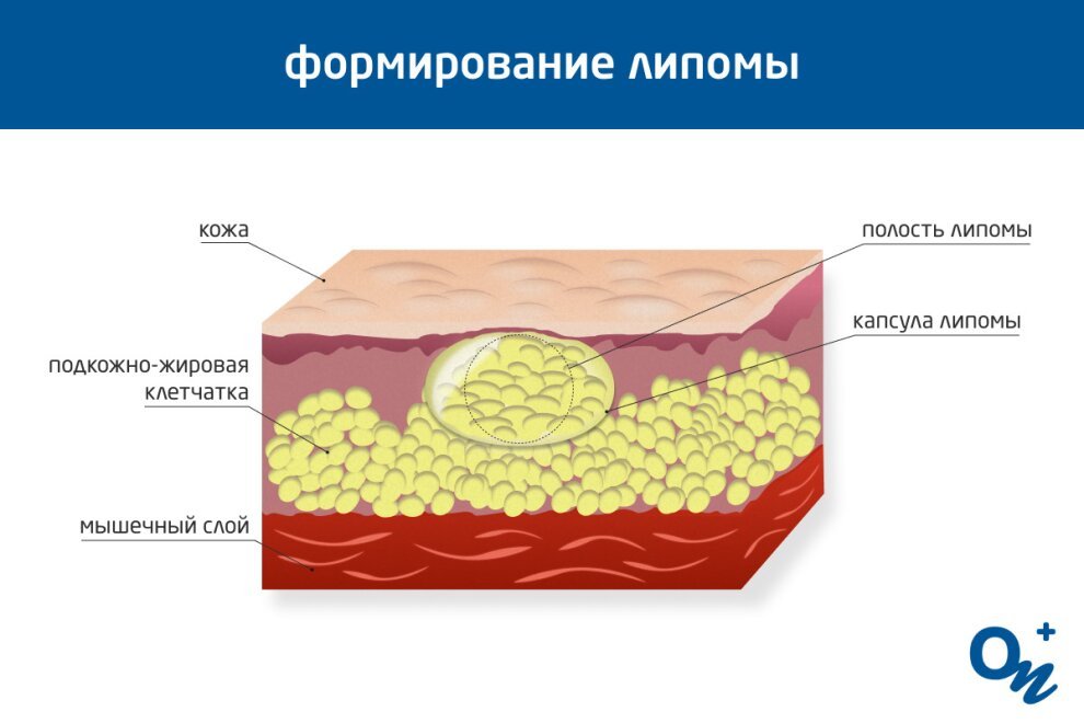 Как выглядит липома на руке фото