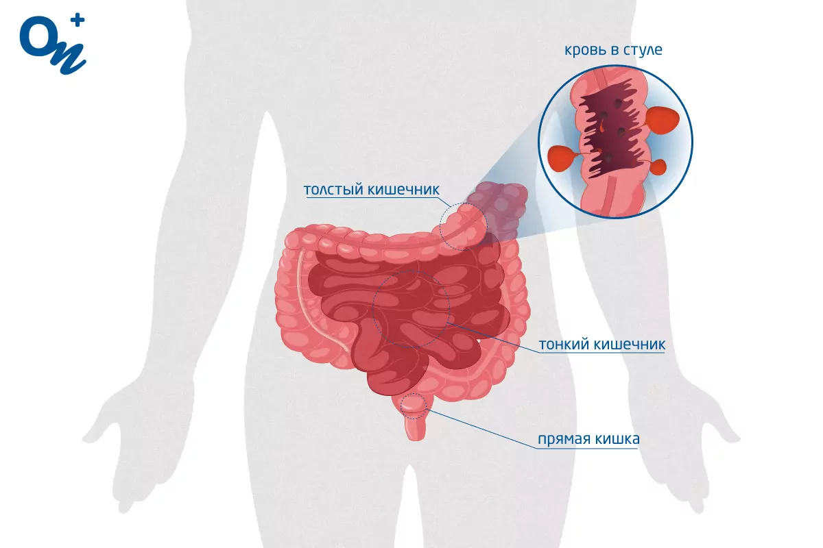 Причины крови в кале и способы её лечения — блог медицинского центра ОН  Клиник