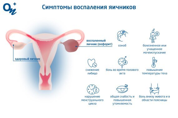 Как понять, что болят яичники — блог медицинского центра ОНКлиник