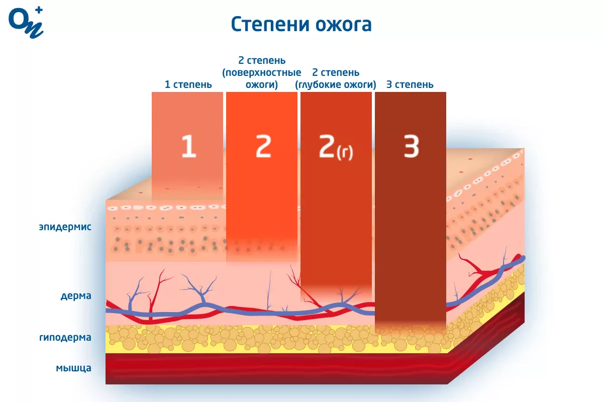 Лечение ожогов в домашних условиях