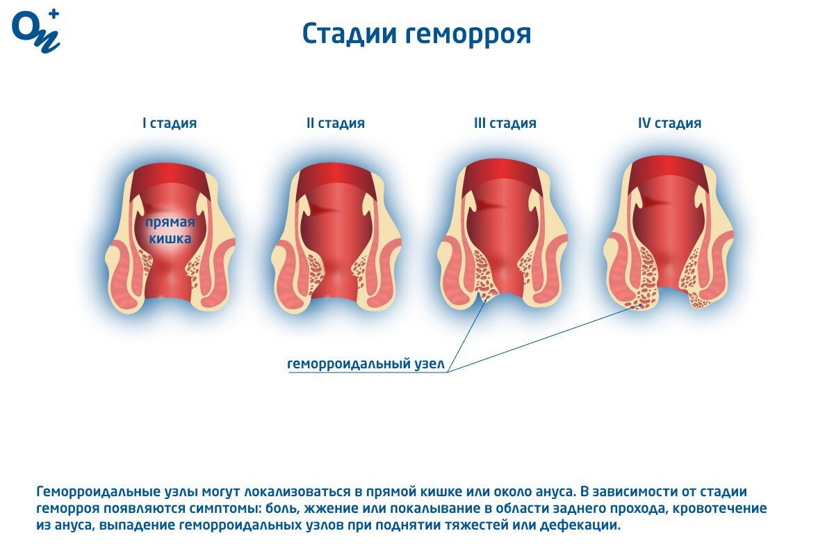 Геморройные узлы или геморройные шишки