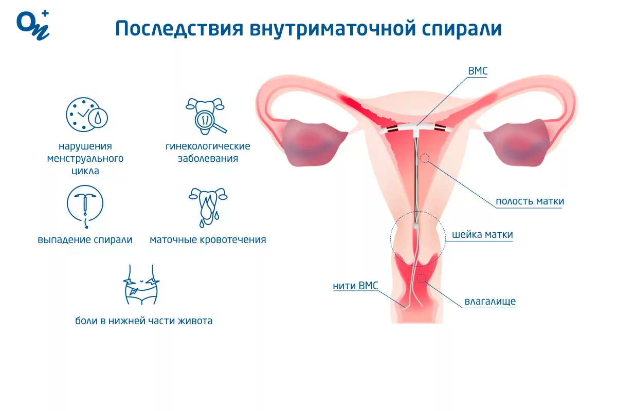 Внутриматочные спирали - за и против