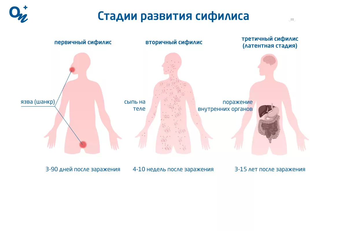 Контагиозность сифилиса и заболеваемость сифилисом после половых контактов