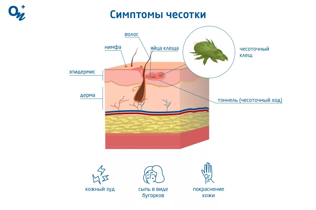 Лечение чесотки, симптомы, причины и как лечить?