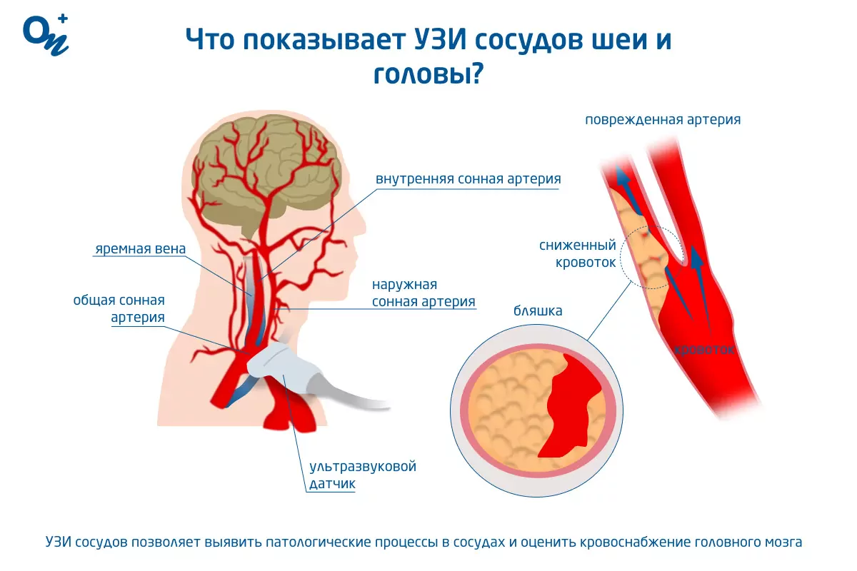 Атеросклероз сосудов головного мозга