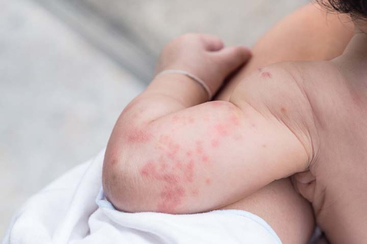 Алергія у дитини на продукти, що містять глютен