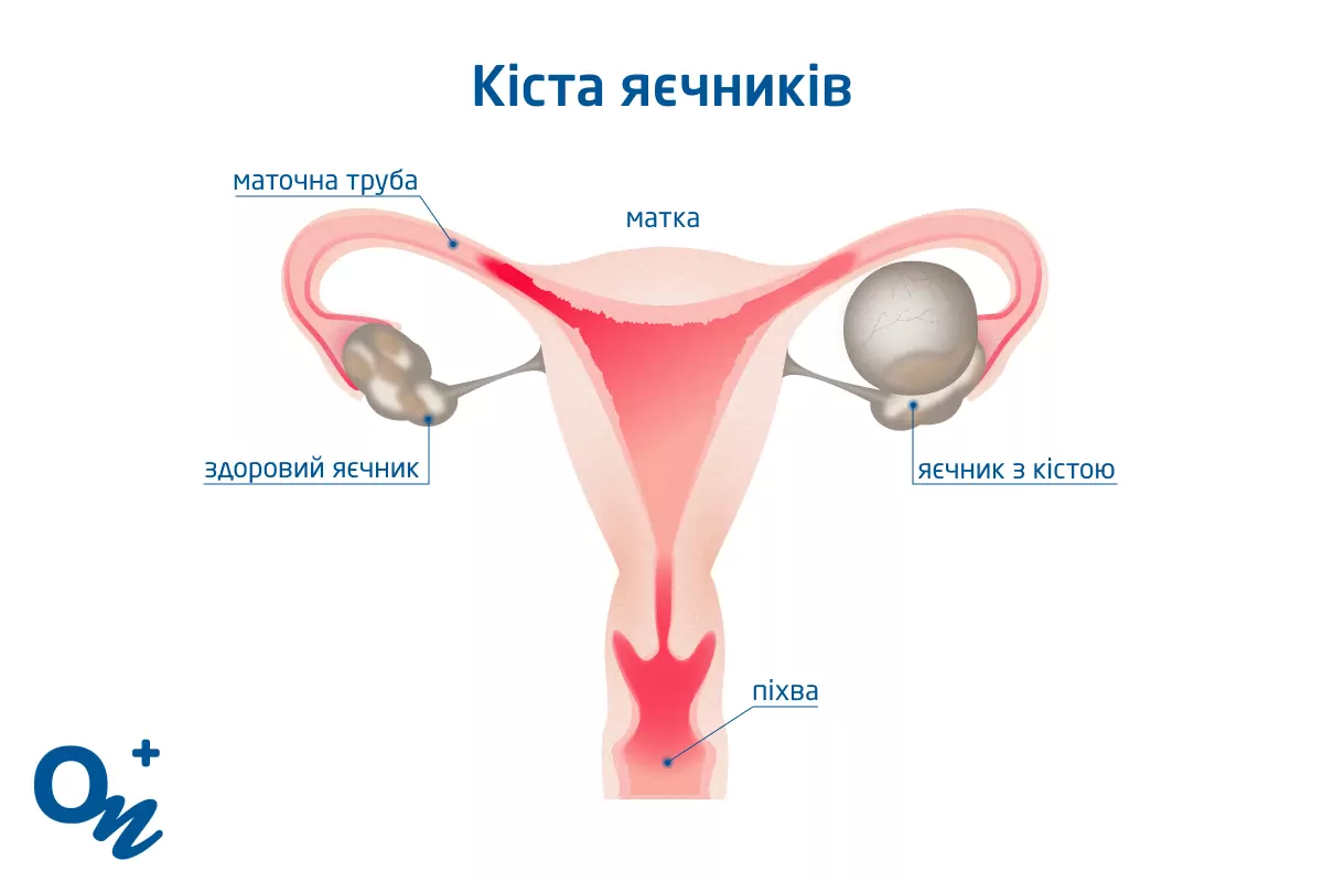 Эндометриоз: как определить и чем он опасен