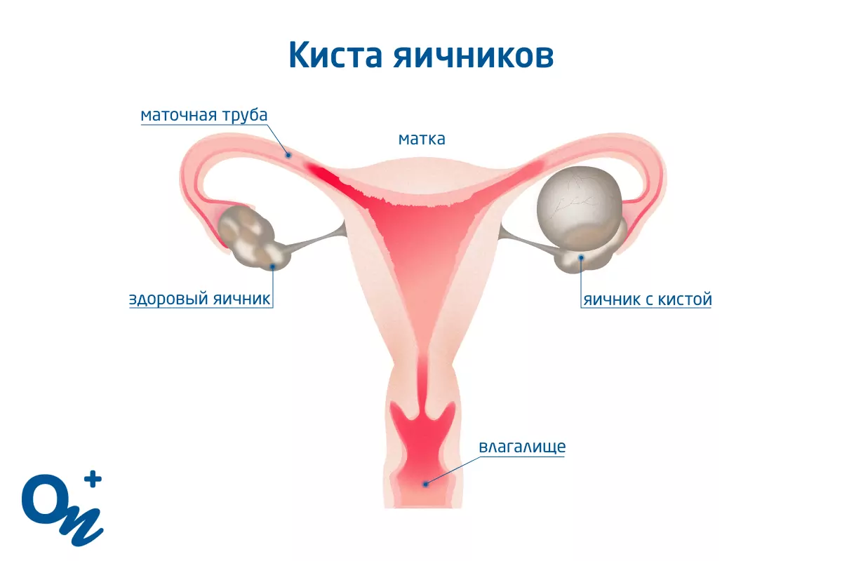 Какой врач лечит боль внизу живота после удаления аппендицита (аппендэктомии)