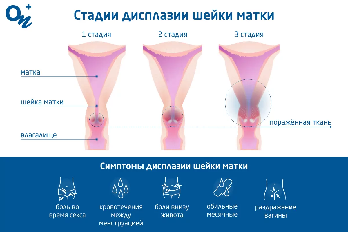 Лечение дисплазии шейки матки в Одессе — гинекология ОН Клиник Одесса