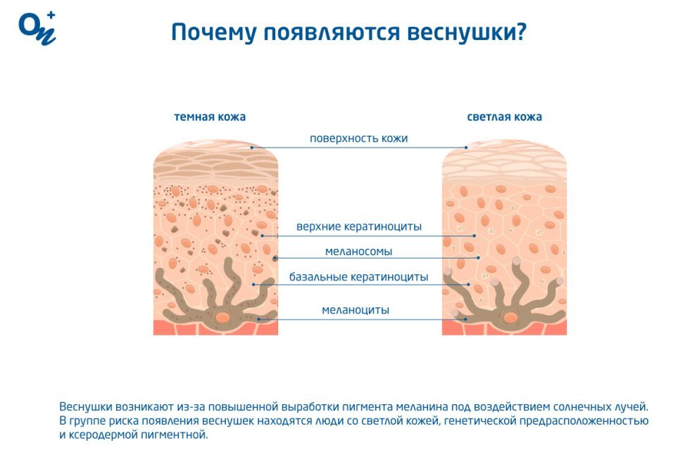 Что такое веснушки и почему они появляются — блог медицинского центра ...