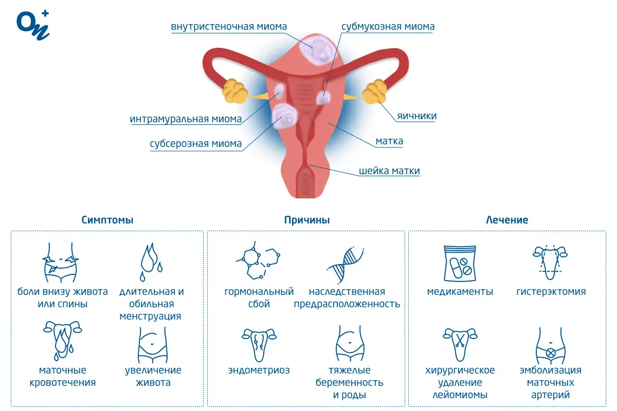 Миома матки: что это? Причины, симптомы и лечение заболевания