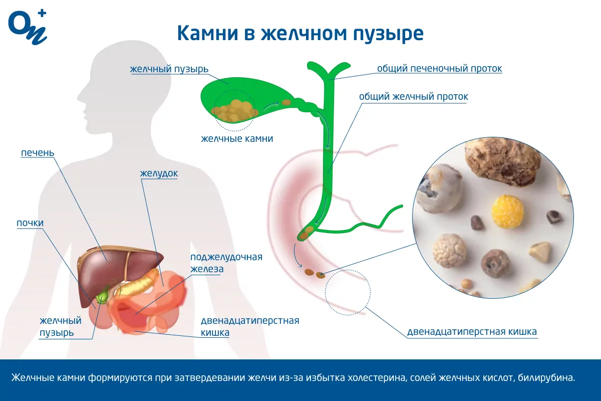 Камни в желчном пузыре: симптомы и когда обратиться к врачу