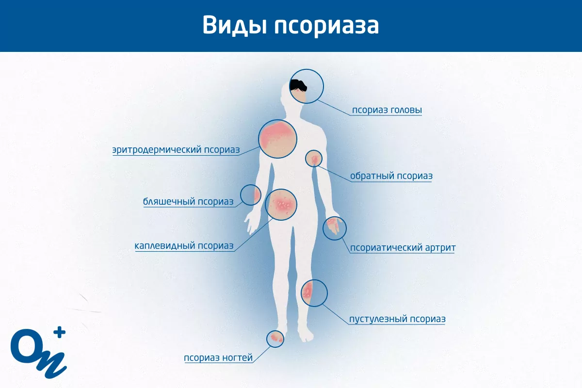 Лечение бляшковидного псориаза народными средствами