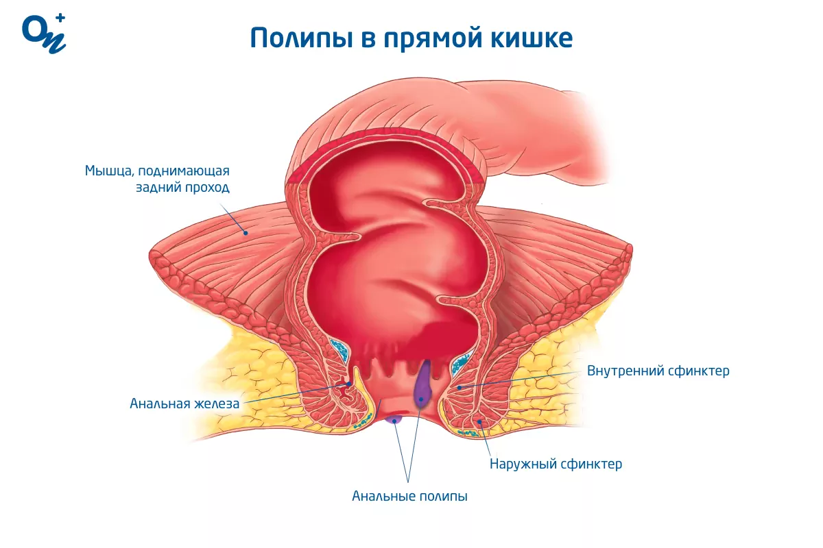 Что такое полипы прямой кишки и почему они возникают — блог медицинского  центра ОН Клиник