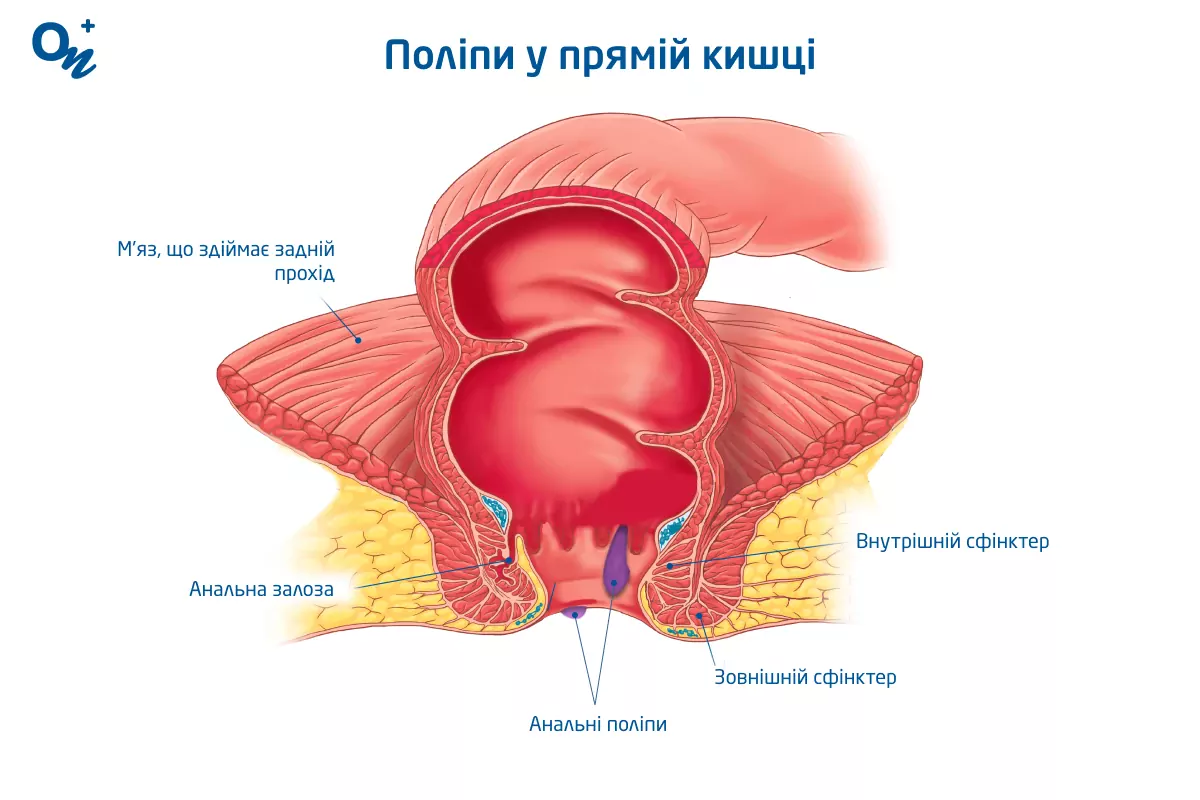 Що таке поліпи прямої кишки і чому вони виникають — блог медичного центру  ОН Клінік