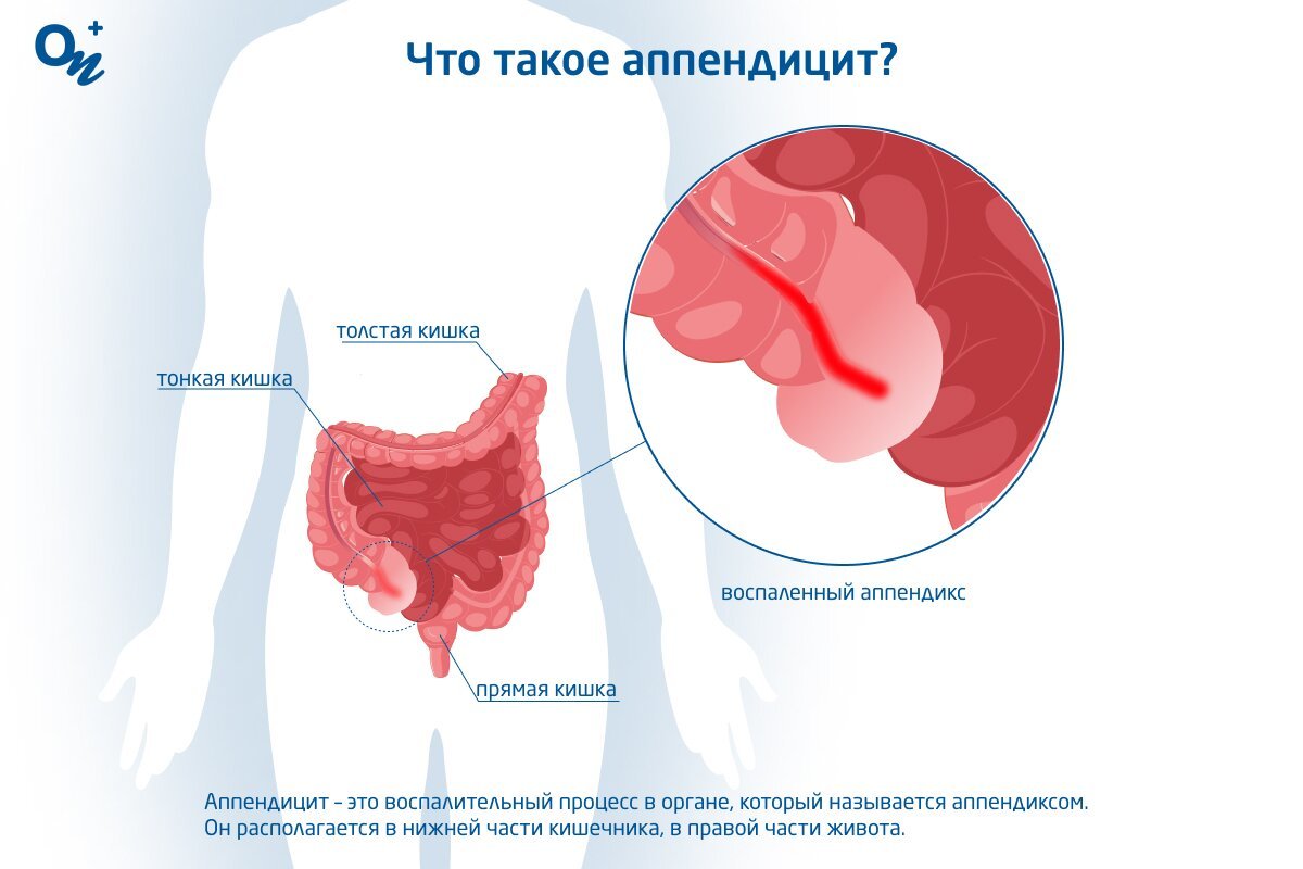 Аппендикс находится в правой нижней части брюшной полости